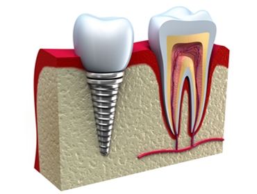 implant - korzeń zęba