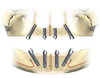 All-on-4 implanty
