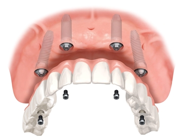 All-on-4 i most w szczęce