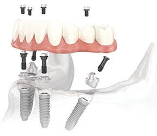 All-on-4 implanty i most w żuchwie